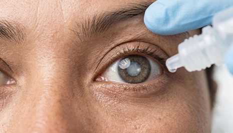 Cataract
